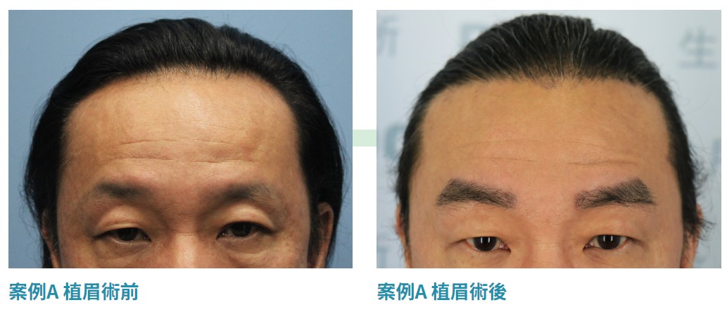 DCDC專業植眉手術，更顯有氣色